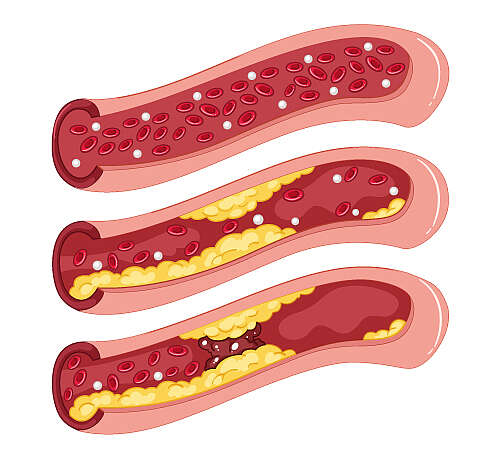 [Translate to Français:] Grafische Darstellung: Illustration der Entstehung von Arteriosklerose. Erkennbar sind eine Arterie, Plaques und rote Blutkörperchen.